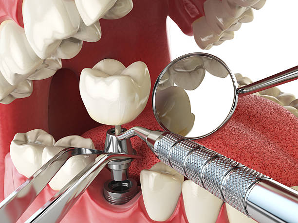 Best Emergency Tooth Extraction in Hobart, WI